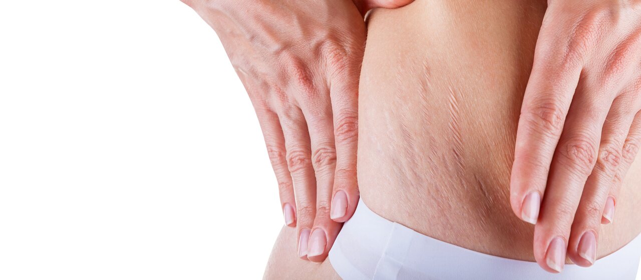 Woman is testing the skin on his stomach on broadly, the presence of stretch marks